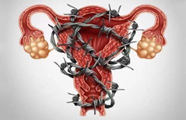 Visa ilustrar de modo figurativo a Endometriose