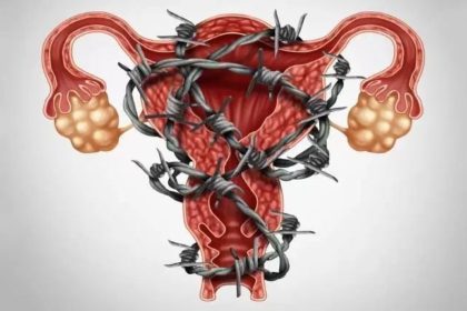 Visa ilustrar de modo figurativo a Endometriose